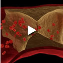 Arteriosclerosis: qué es y qué consecuencias tiene