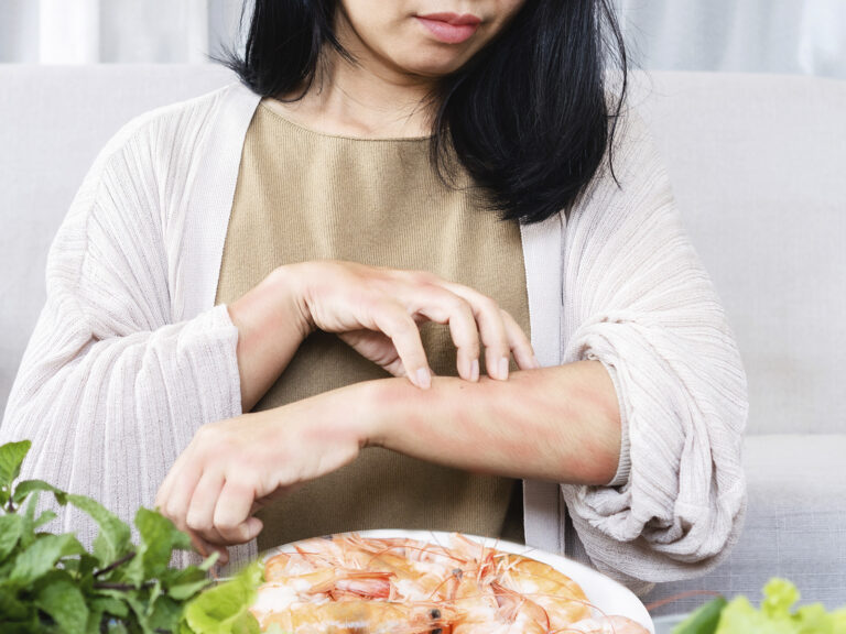 Mujer con alergia al pescado mostrando reacción en brazo